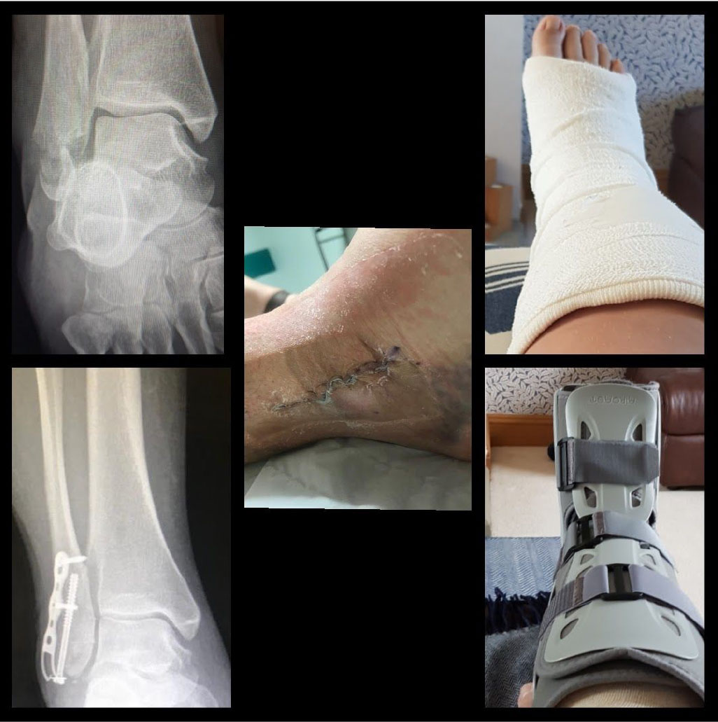 Gillian badly broke her ankle in 2019 she snapped off the bottom of her fibula and shattered bones around her ankle joint leaving it out of alignment and twisted.
